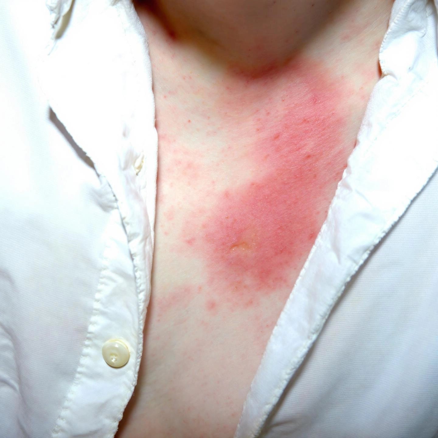 common side effects of aluminum based antiperspirants such as skin irritation and yellow stains
